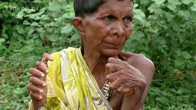 Жительница Индии имеет 12 пальцев на руках и 19 на ногах