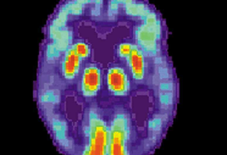 Новое сканирование позволило измерить метаболическую активность в мозге 45 человек с диагнозом болезни Альцгеймера