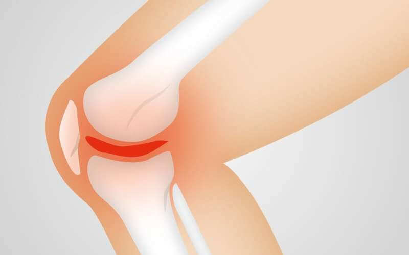 Обнаружена возможная мишень для лечения и профилактики остеоартрита